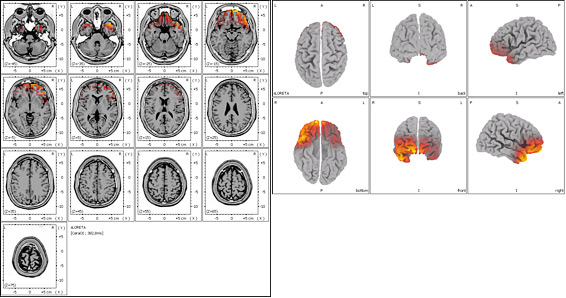 Tomografía Eléctrica Cerebral en paciente con comienzo de Enfermedad de Alzheimer
