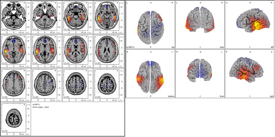 Tomografía Eléctrica Cerebral en paciente con lesiones vasculares cerebrales