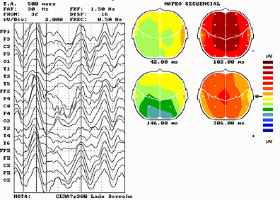 Potenciales evocados mapeados