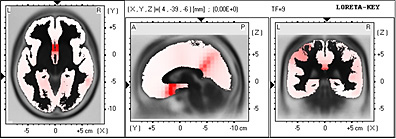 Vestibular migraine may be an important cause of dizziness/vertigo in  perimenopausal period - ScienceDirect