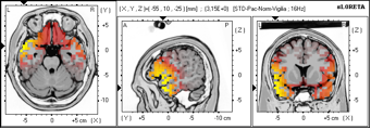 Variación ritmo cerebral